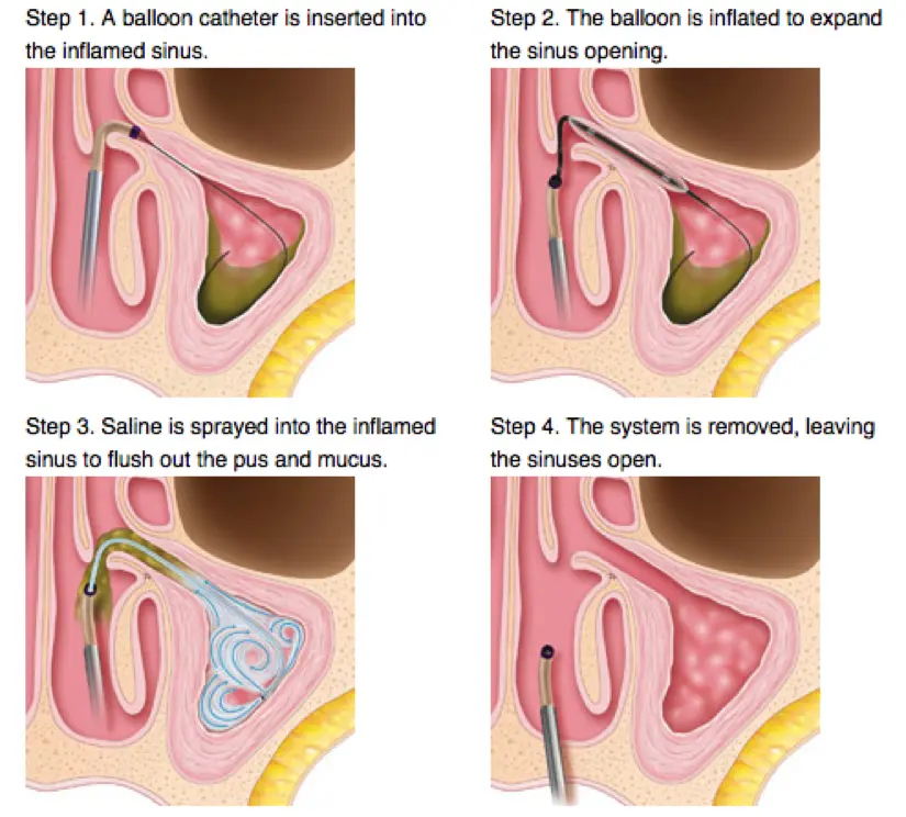 Balloon Sinus Steps 1 insert balloon catheter, 2 balloon is inflated to expand sinus opening, 3 saline is sprayed, 4 system is removed