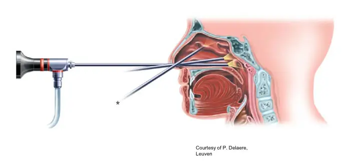 nasal endoscopy