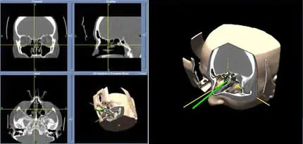 Surgical Navigation
