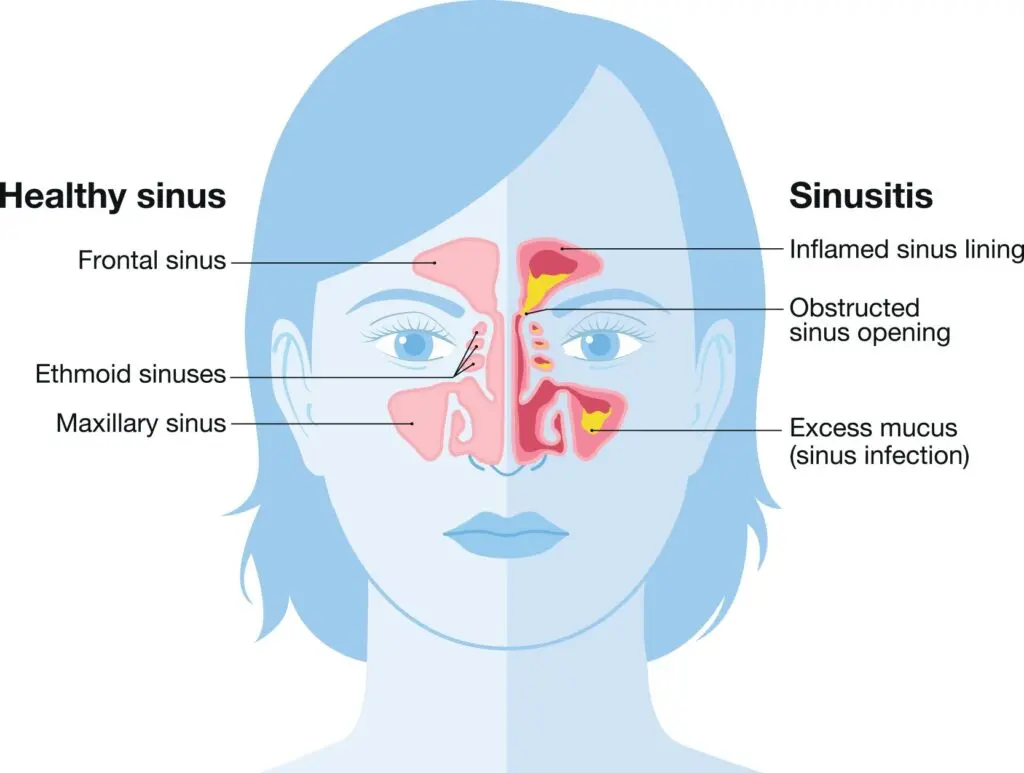 Infographic of a woman and the difference between a healthy and infected sinus